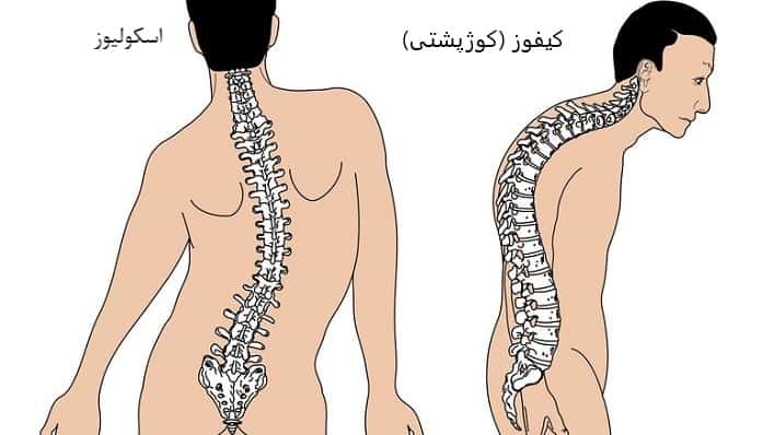 اسکولیوز و کیفوز (کوژپشتی) چیست؟