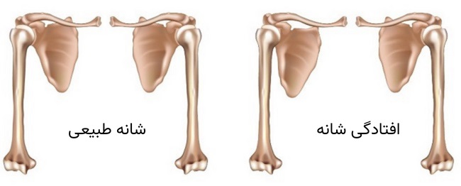 افتادگی شانه چیست؟