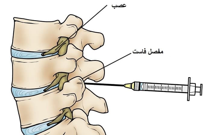 بلاک عصب مفصل فاست ناحیه لومبر