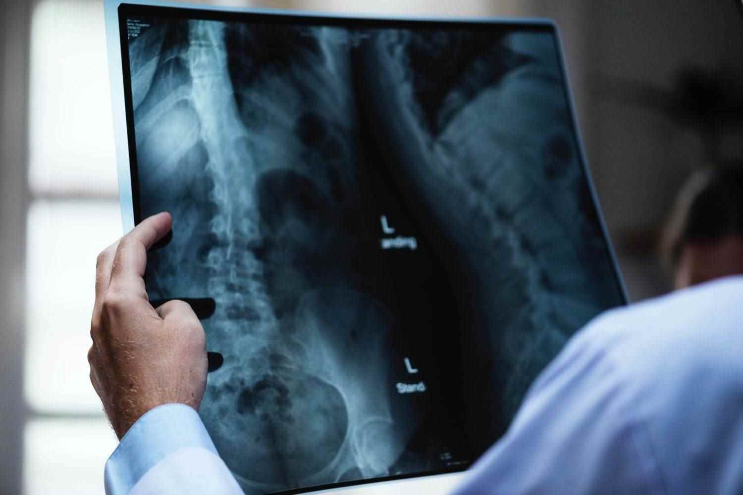 تشخیص میزان انحنای ستون فقرات قبل از کایروپراکتیک اسکولیوز