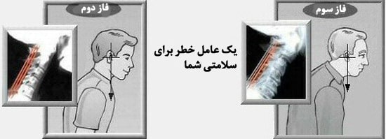 تعریف سر و گردن به جلو