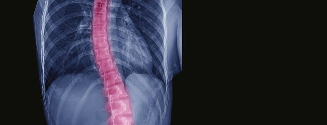 جراحی اسکولیوز چه زمانی لازم است؟