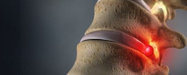 دلایل رایج بیرون زدگی دیسک کمر