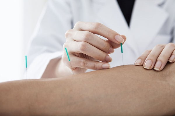 طب سوزنی از روش های فیزیوتراپی ستون فقرات