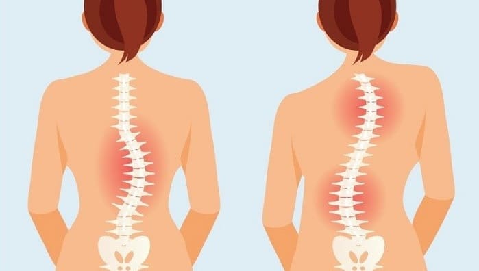 چگونه اسکولیوز دژنراتیو ایجاد می شود؟