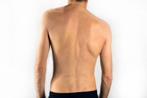 اسکولیوزیس به علت تروما