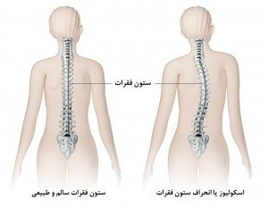 درمان اسکولیوز