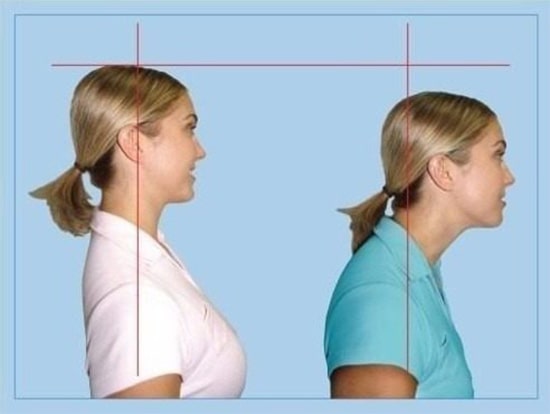 درمان سر وگردن به جلو (قوس گردن) با فیزیوتراپی و ورزش