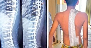 هزینه جراحی اسکولیوز برای کودکان و بزرگسالان چقدر است؟